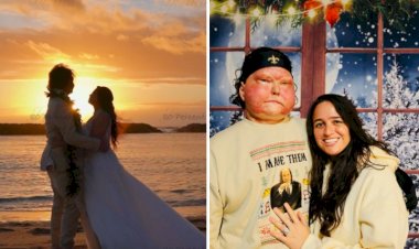 Homem que fez transplante de rosto vira influencer e celebra ‘segunda chance na vida’