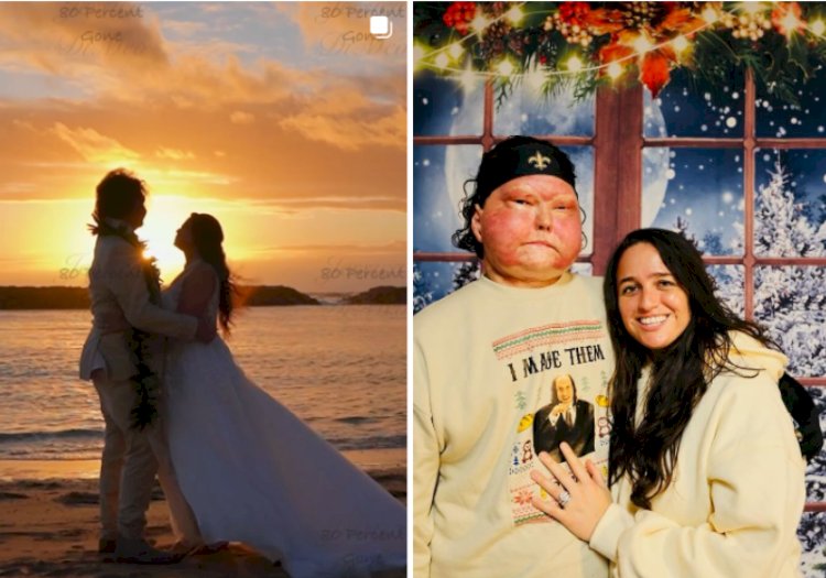 Homem que fez transplante de rosto vira influencer e celebra ‘segunda chance na vida’